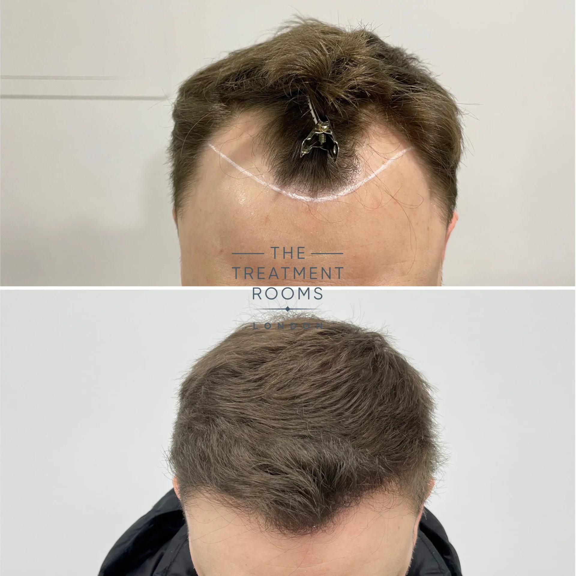 receding temples hair transplant london 1314 grafts before and after