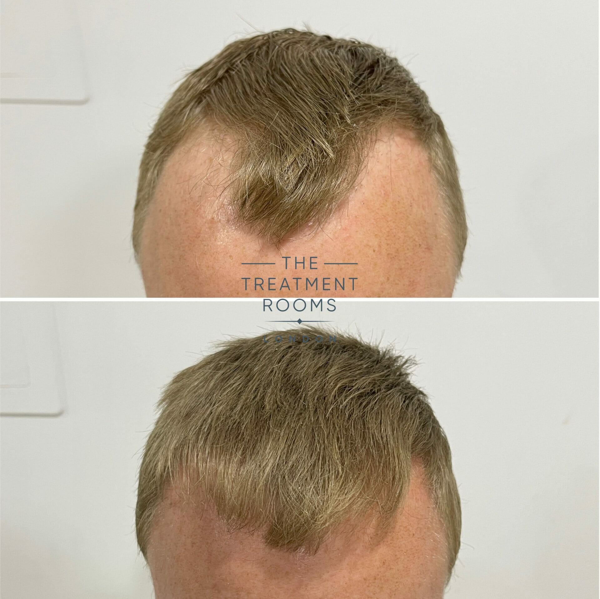repair hair transplant before and after repair hair transplant before and after