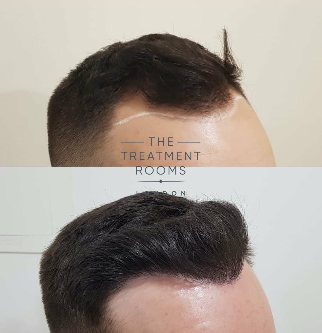 right-hairline-FUE-hair-transplant hairline fue hair transplant before after 1292 grafts
