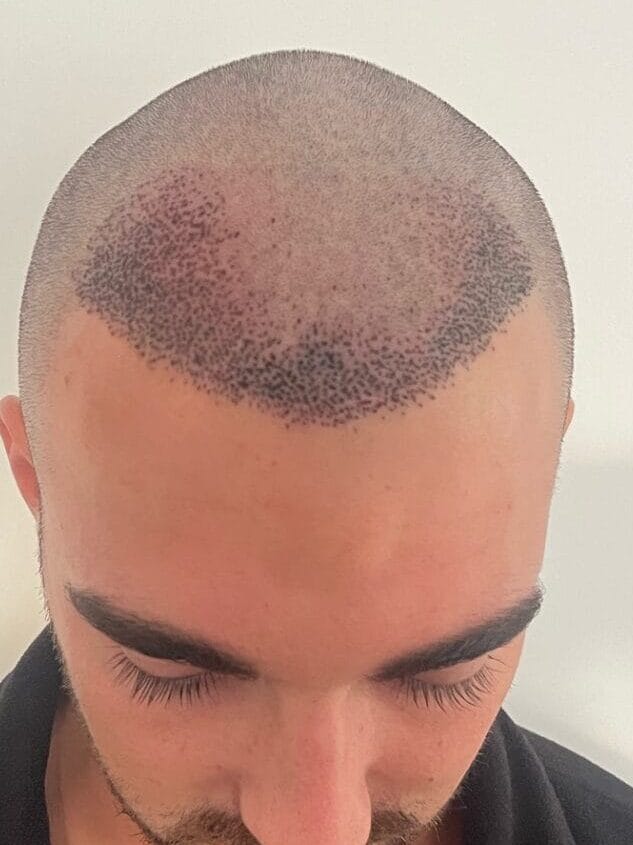 scabs after hair transplant