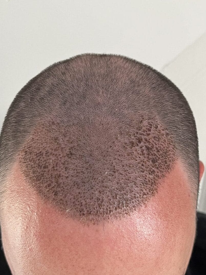 scabs after hair transplant