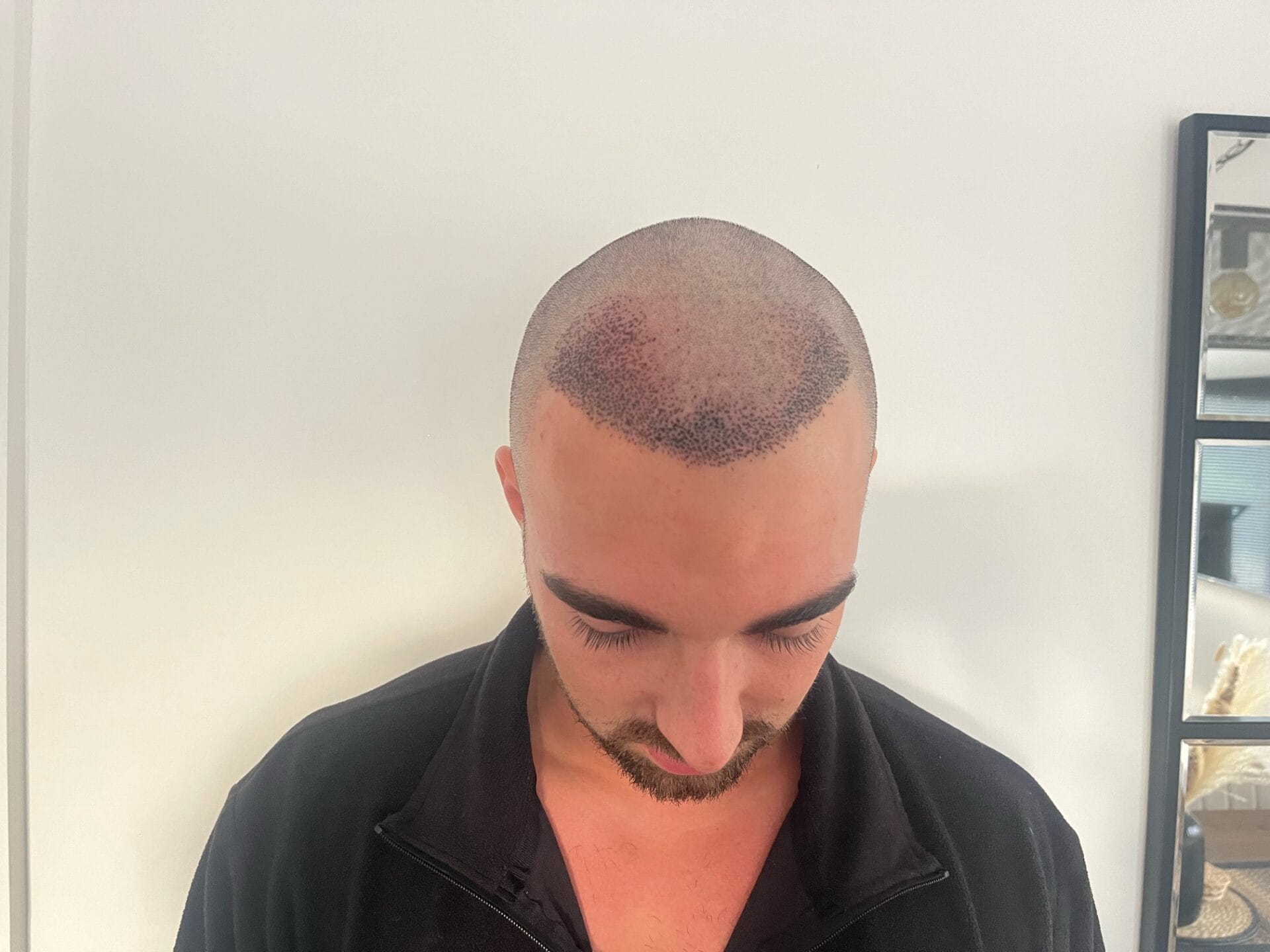 scabs after hair transplant