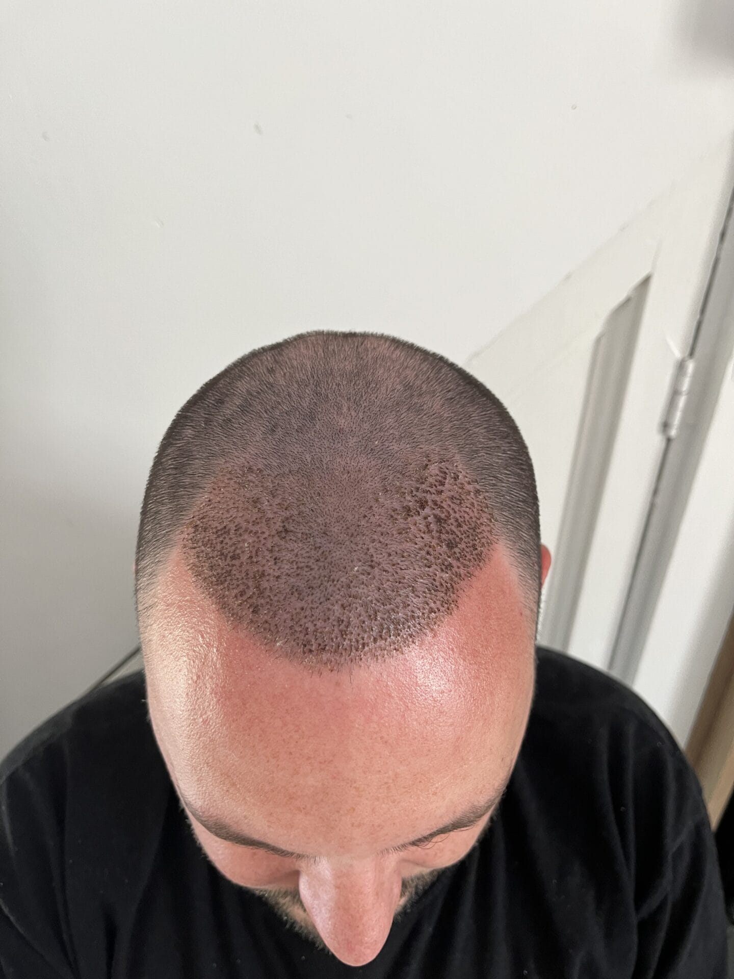 scabs after hair transplant