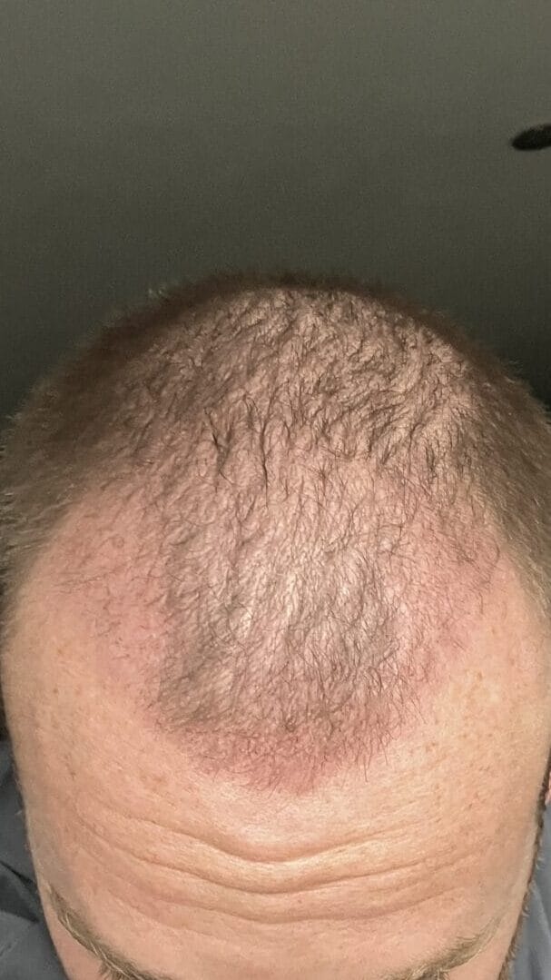 shaving head after hair transplant