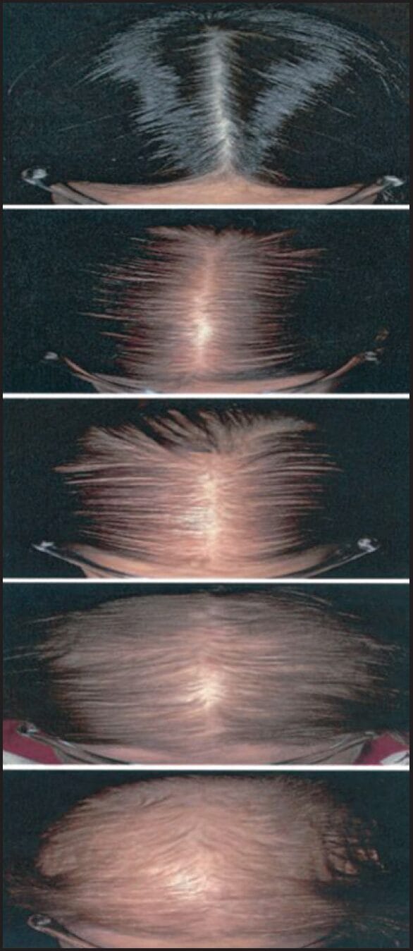 sinclair scale of female hair loss