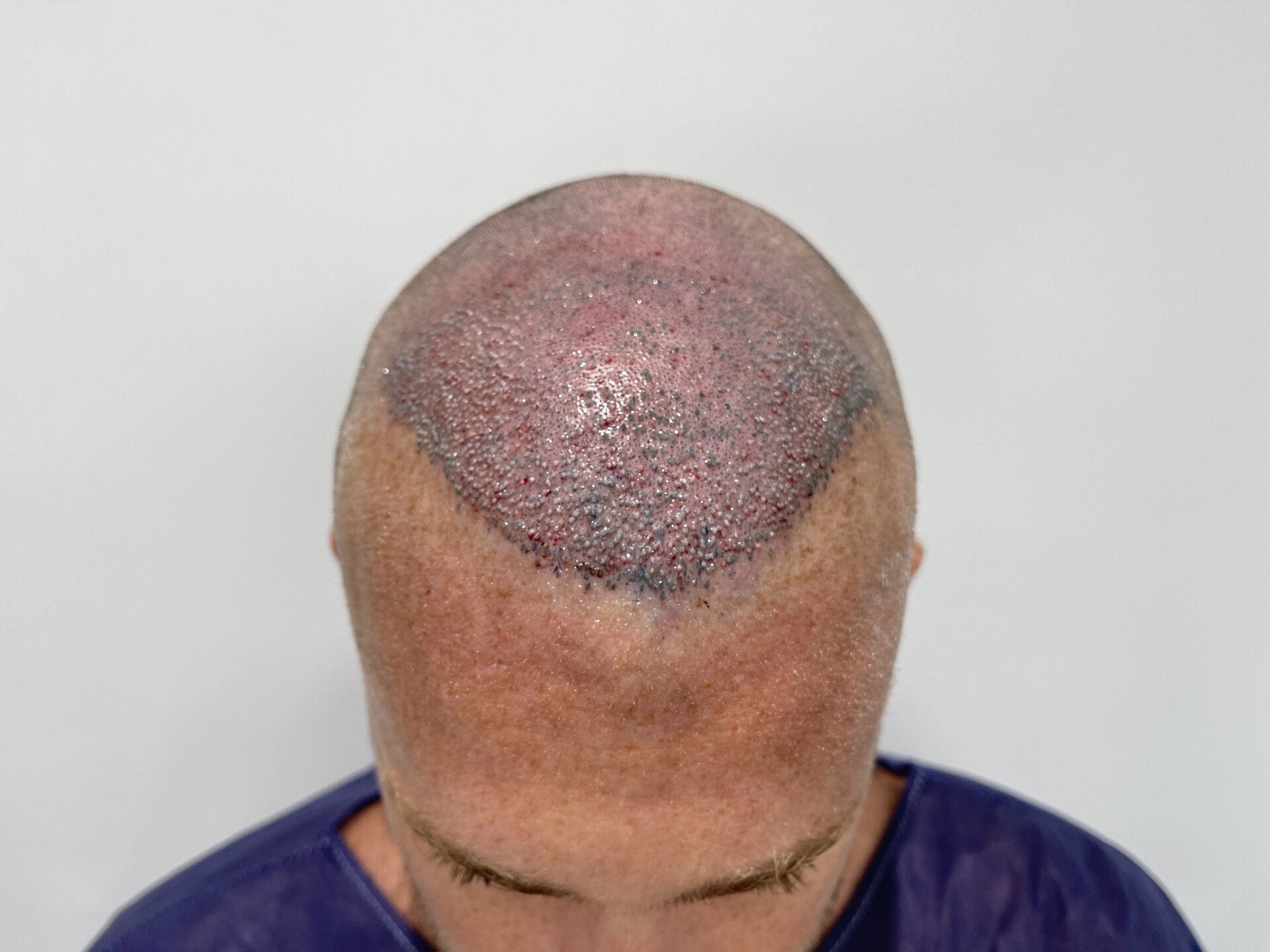 swelling after hair transplant