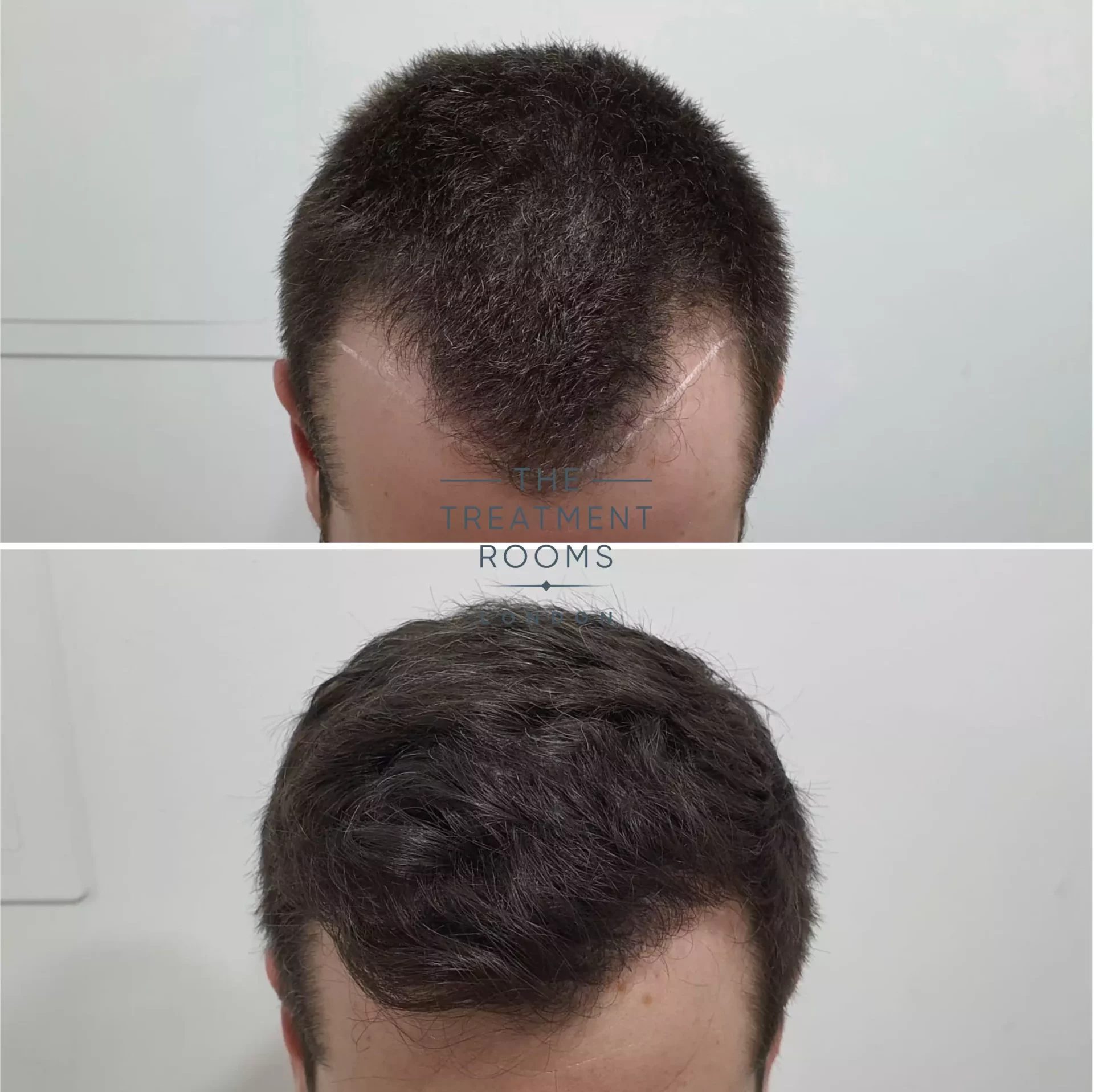 Temple Hair Loss & Temple Hair Transplant | Treatment Rooms London