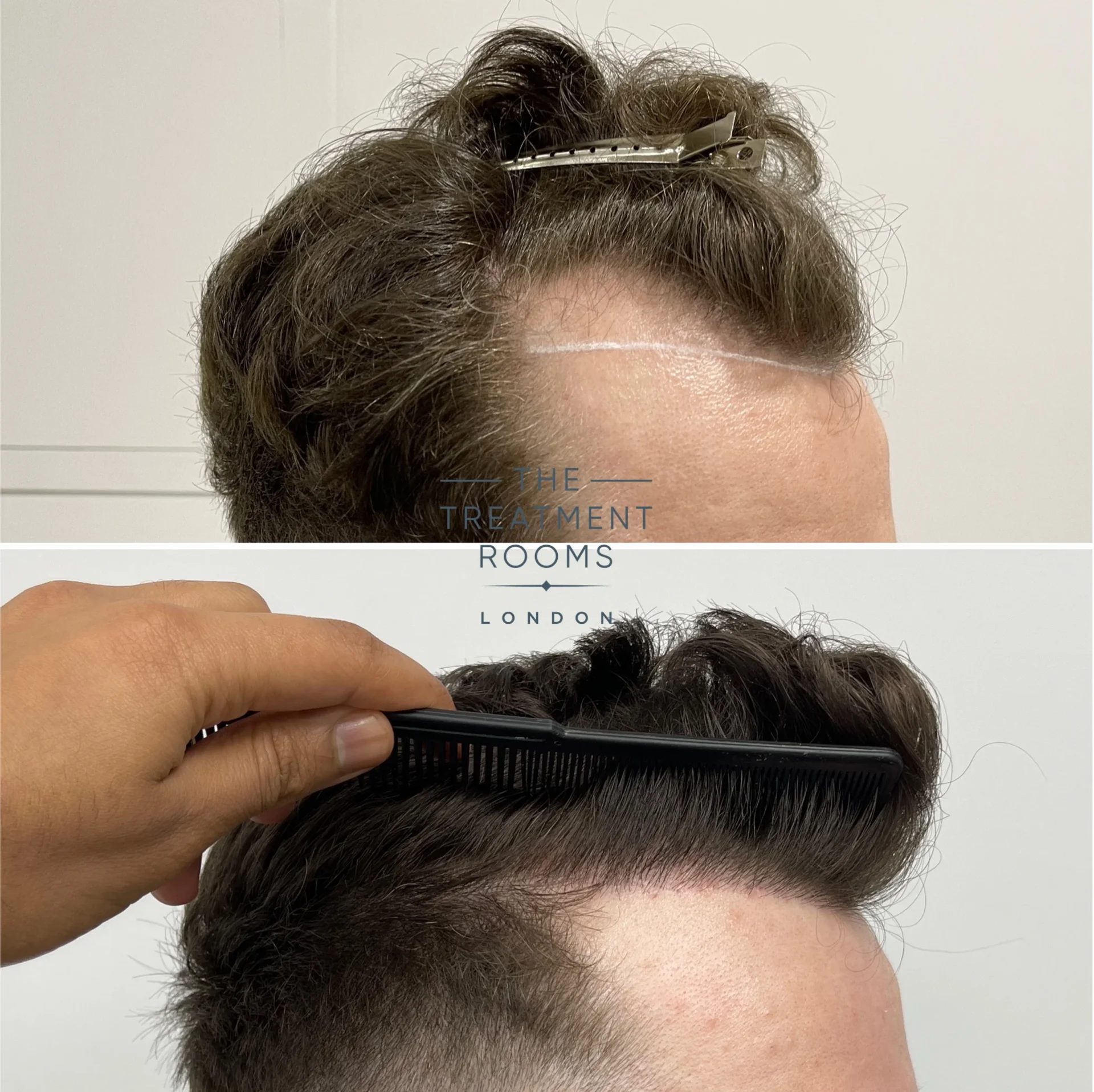 temple hair transplant 1145 grafts before and after detailed temple hair transplant 1145 grafts before and after detailed