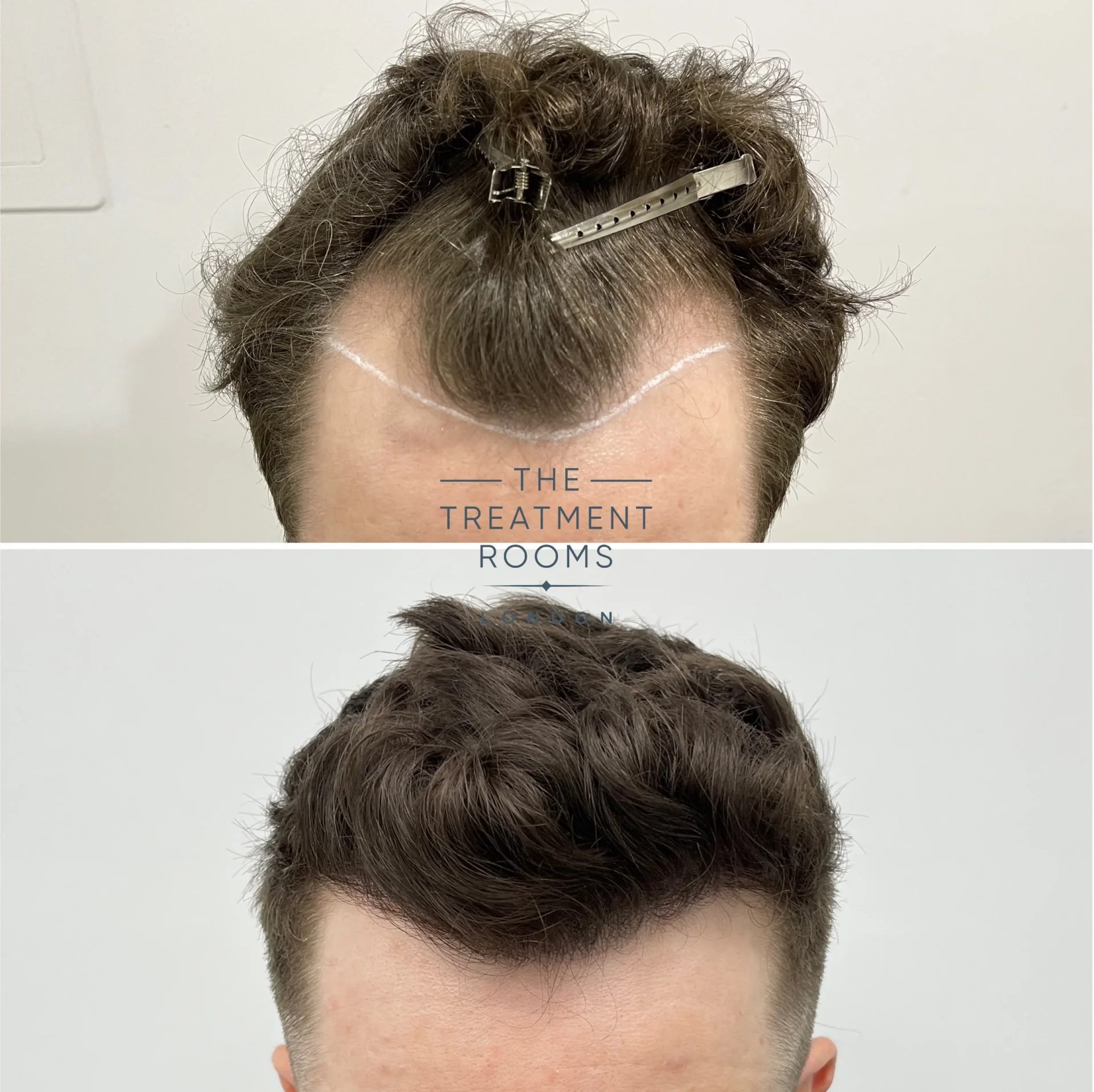 temple hair transplant 1145 grafts before and after