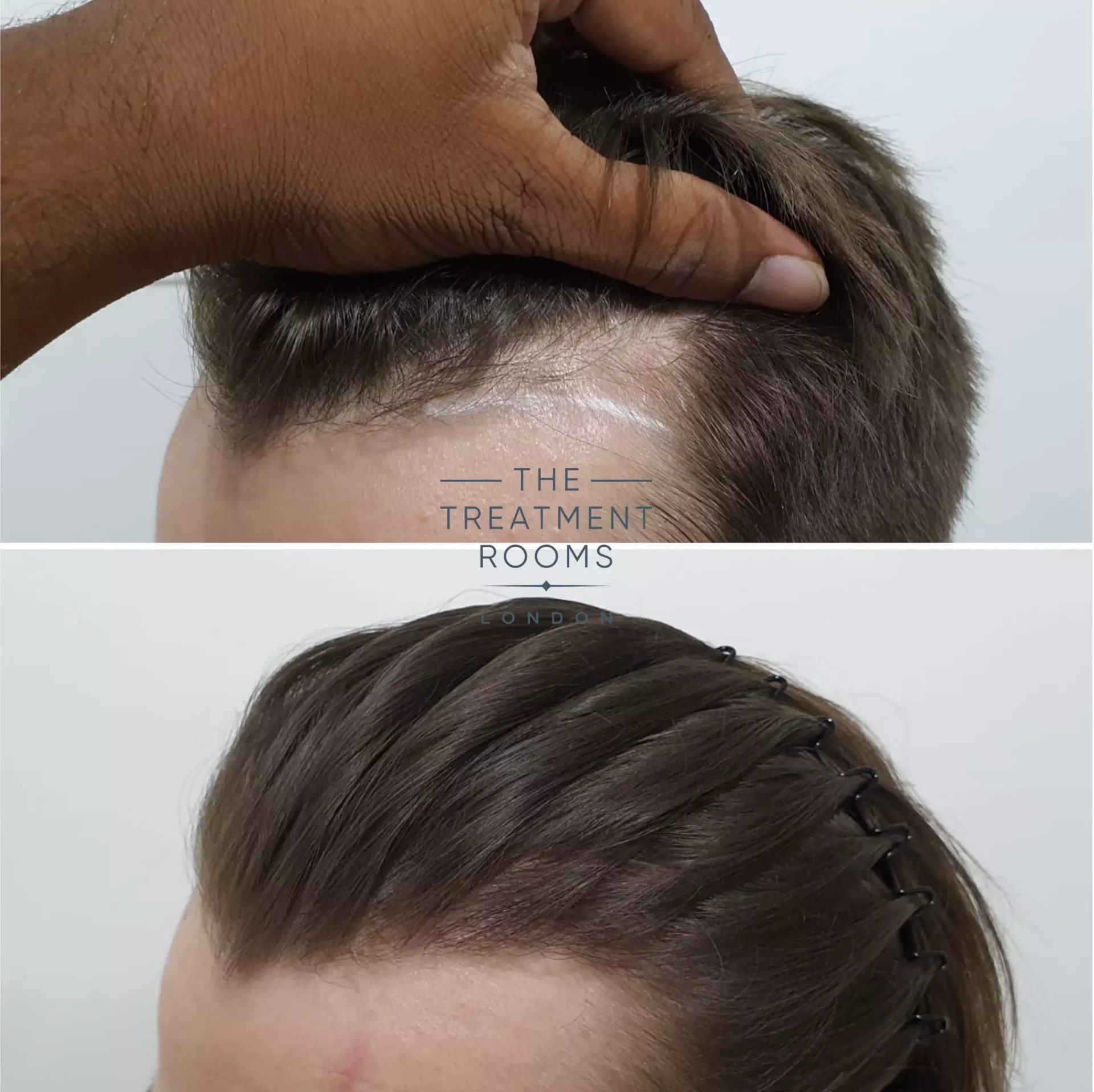 Temple Hair Loss & Temple Hair Transplant | Treatment Rooms London