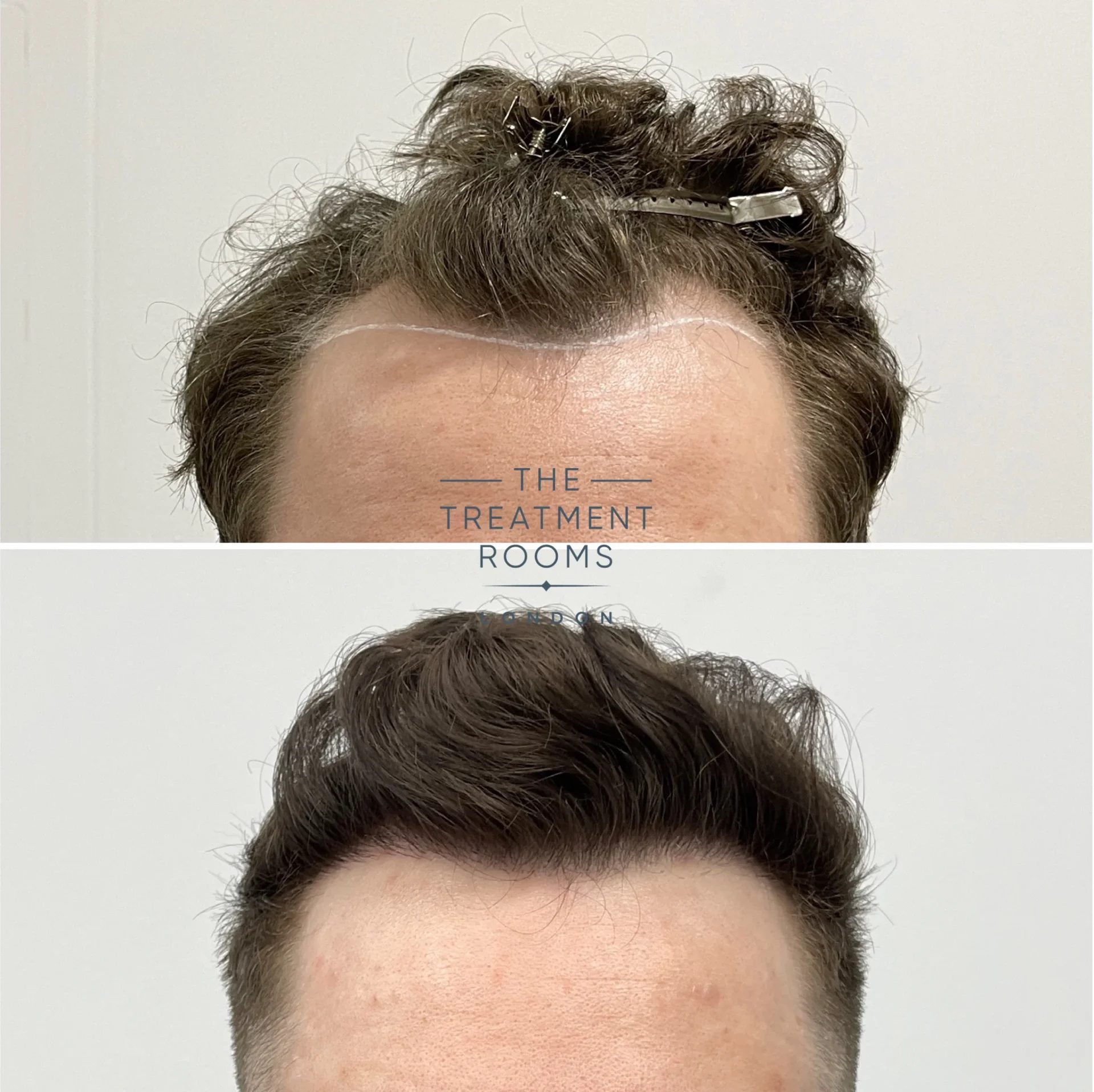 temple hair transplant clinic 1145 grafts before and after