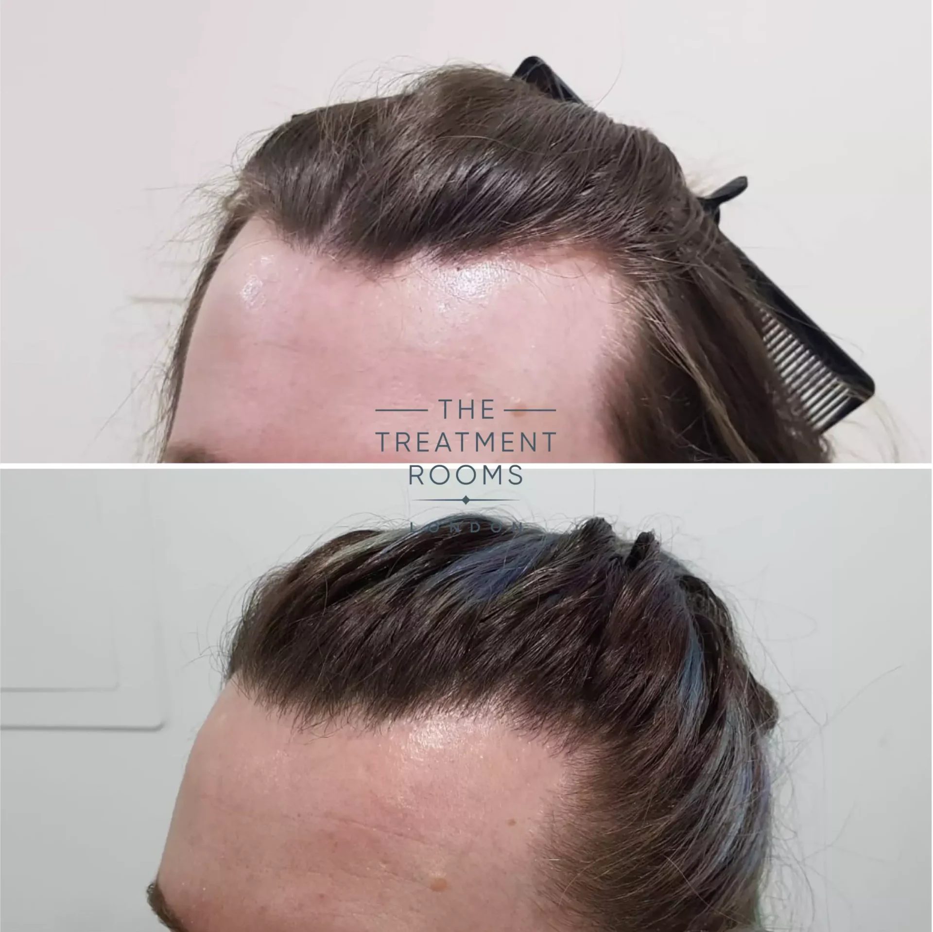 temple hair transplant mild feminisation 1253 grafts