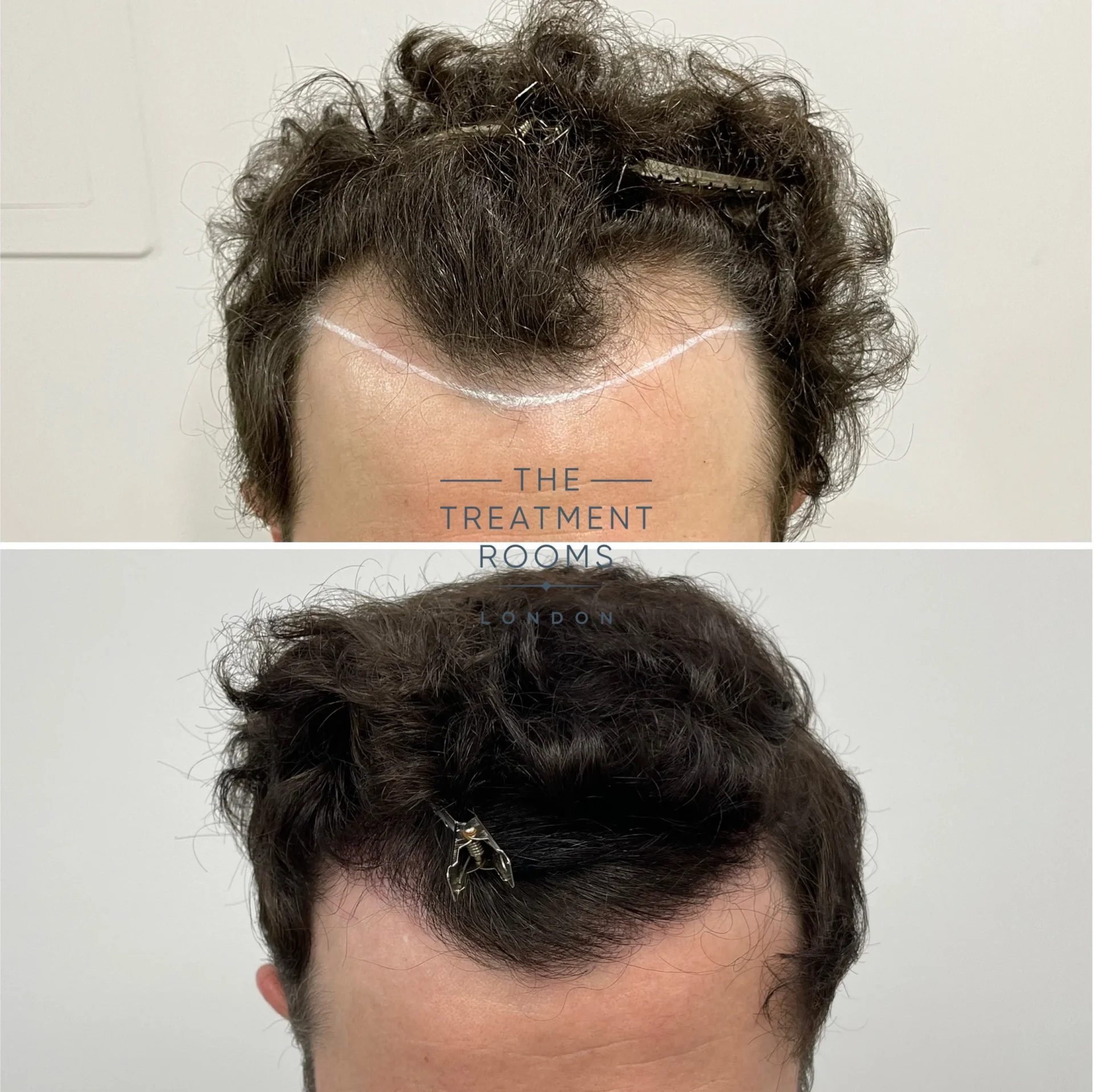 temples and hairline fue transplant before and after 1306 grafts