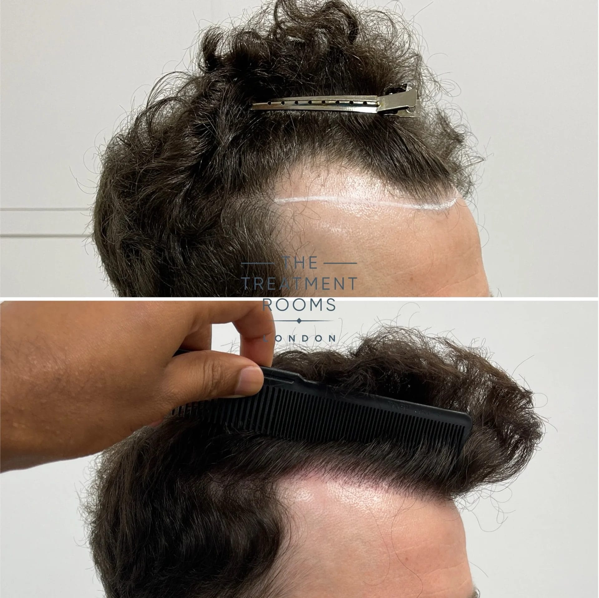 temples and hairline transplant before and after 1306 grafts
