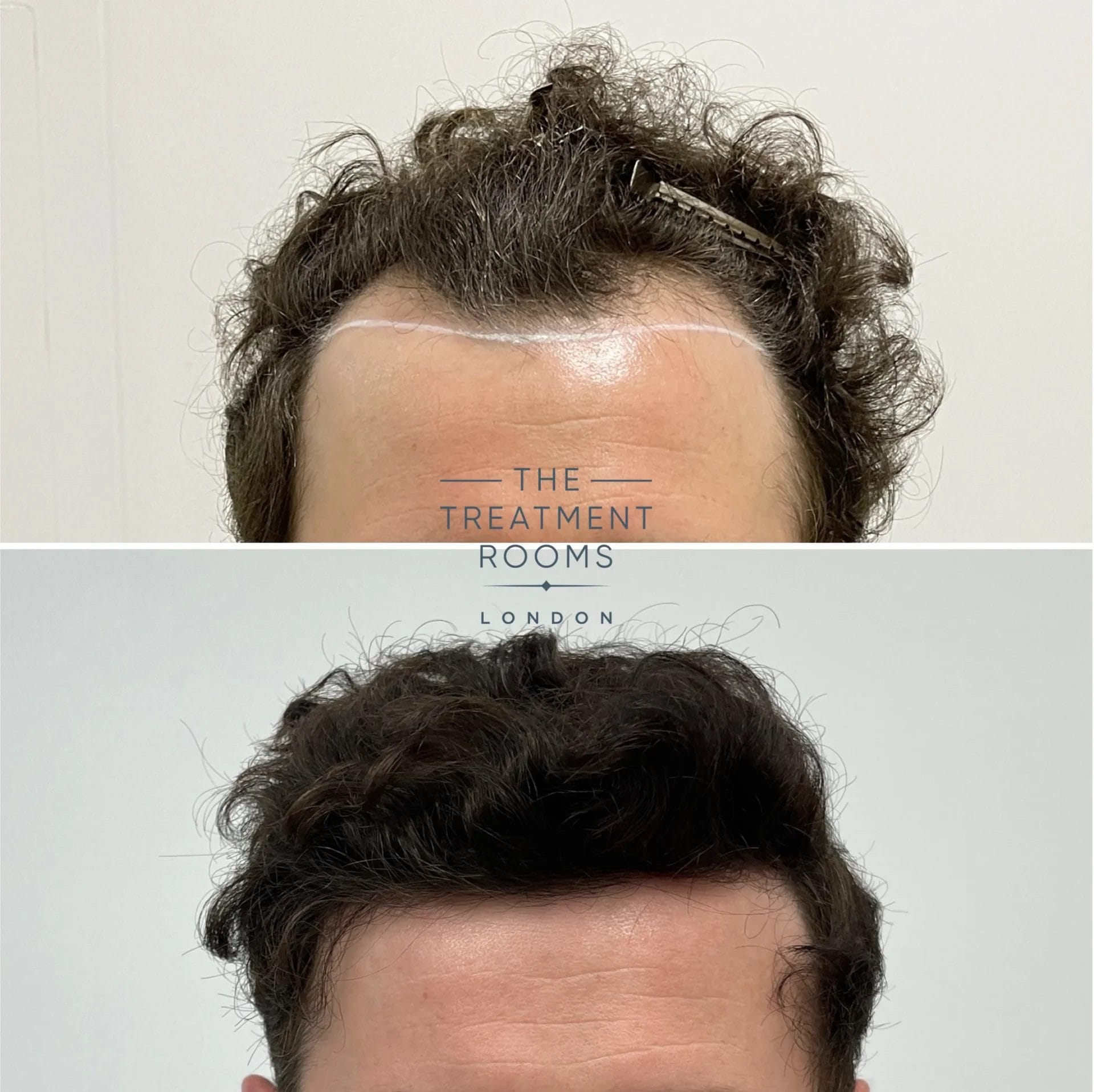 temples and hairline transplant result 1306 grafts