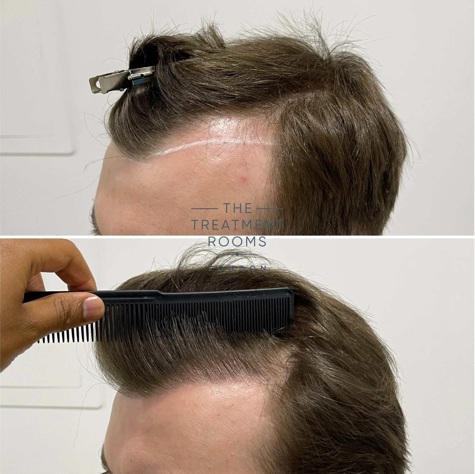 Temple Hair Loss & Temple Hair Transplant | Treatment Rooms London