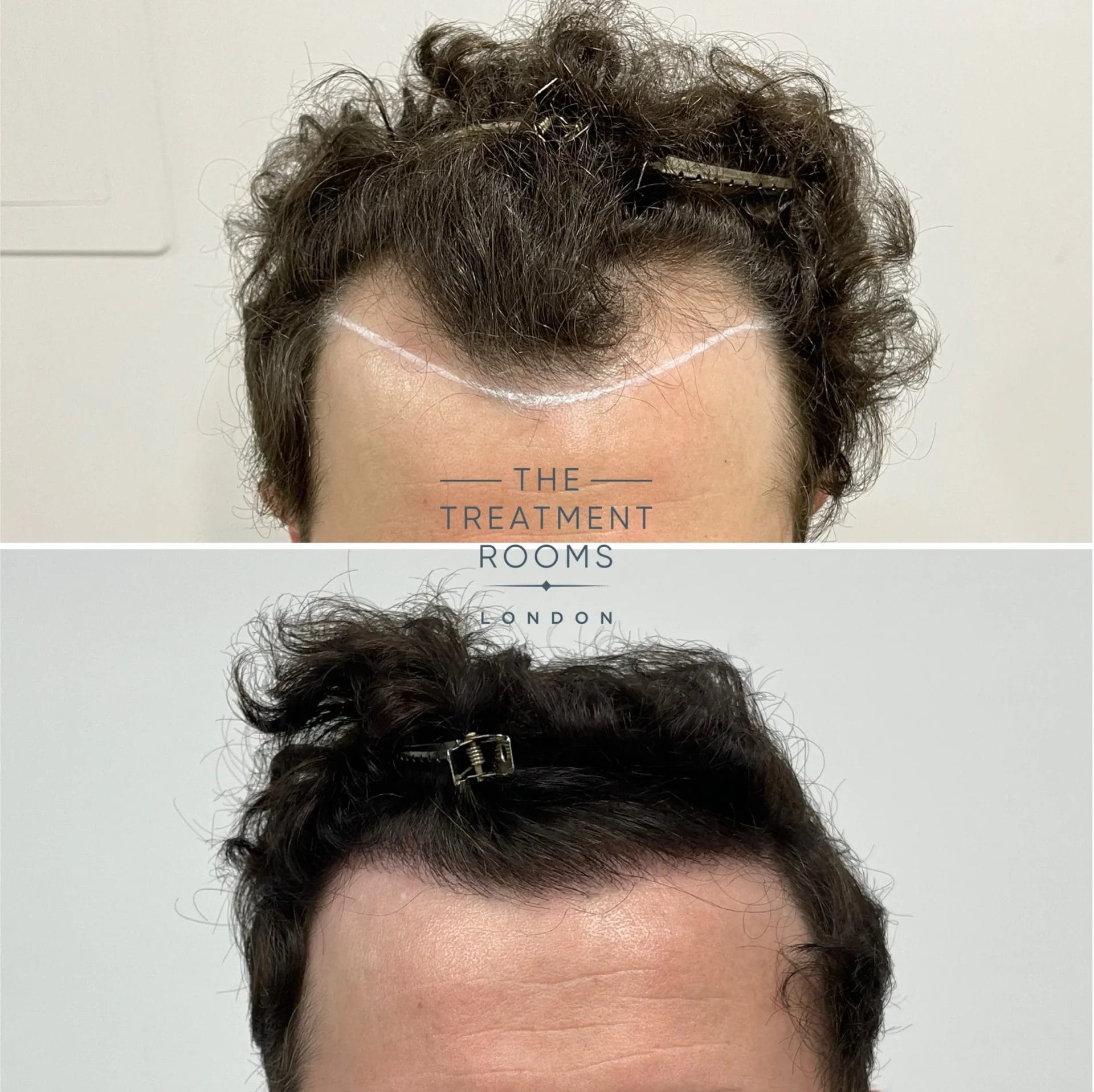 temples hairline fue transplant before and after 1306 grafts