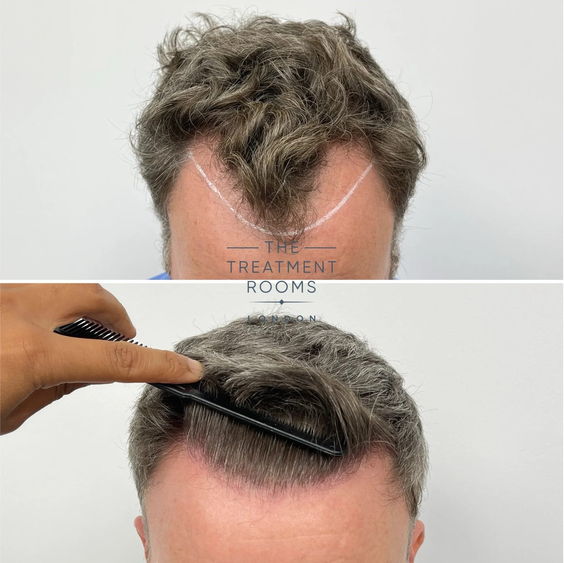 thick hair type 1988 grafts before and after