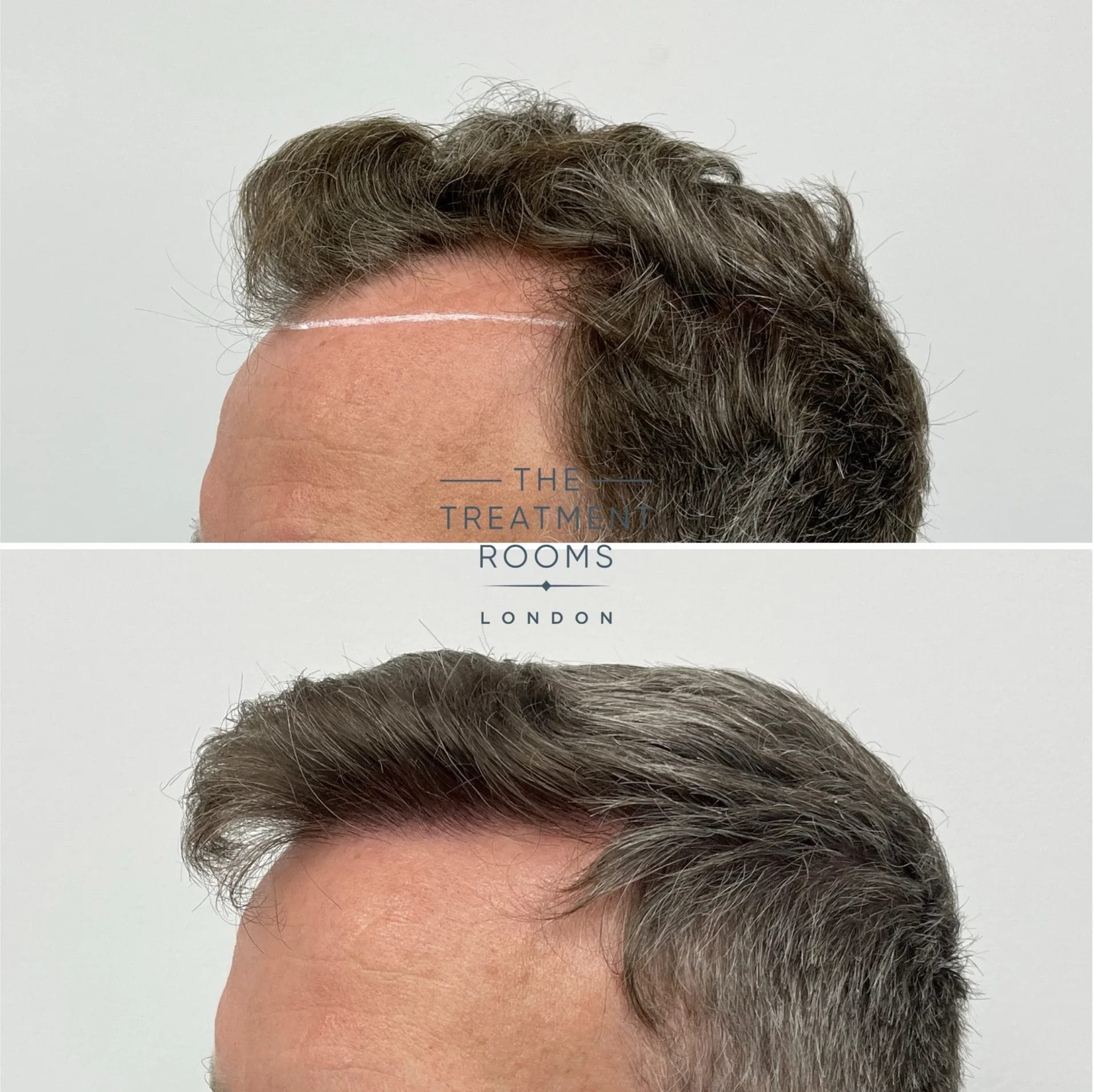 thick hair type 1988 grafts fue hair transplant before and after