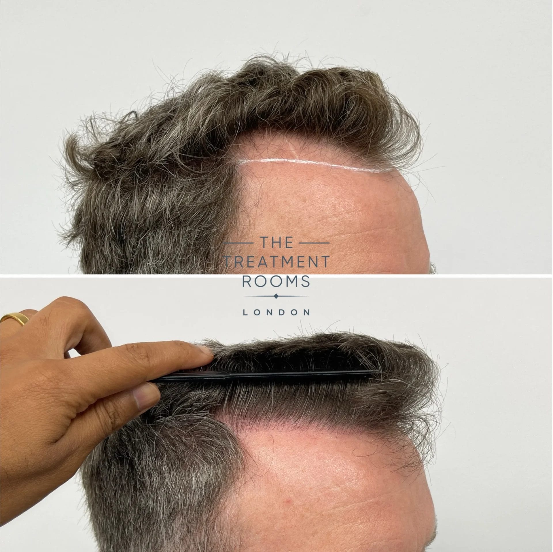thick wavy hair type 1988 grafts fue hair transplant before and after