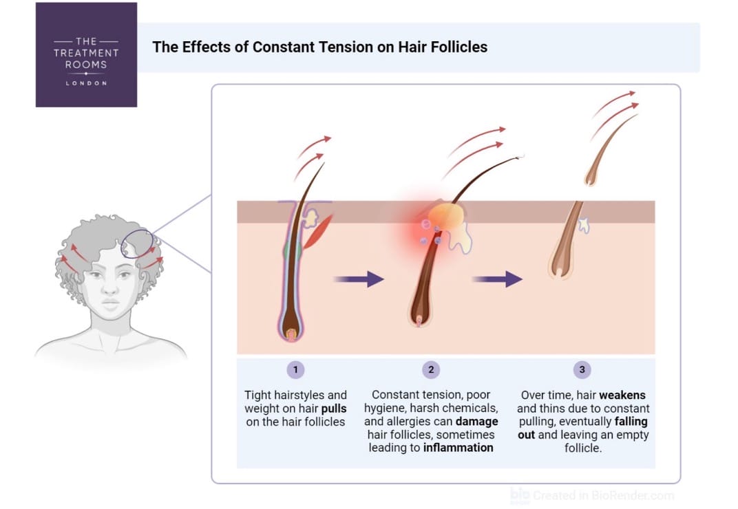 traction alopecia and hair tension diagram