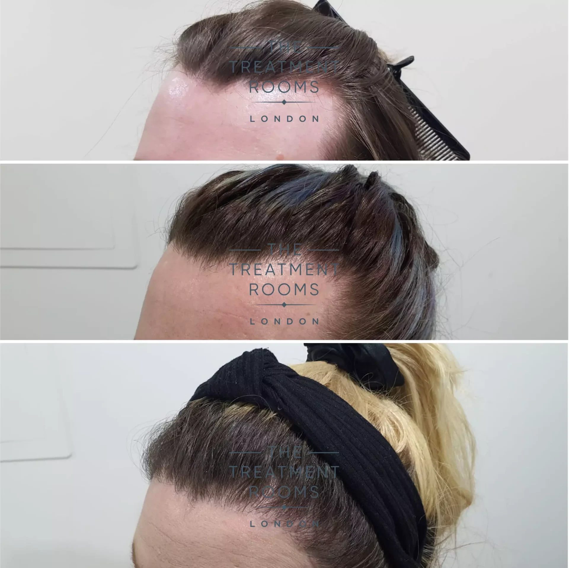 transgender hair transplant 2319 grafts before and after