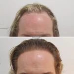 transgender hair transplant before and after 1509 grafts