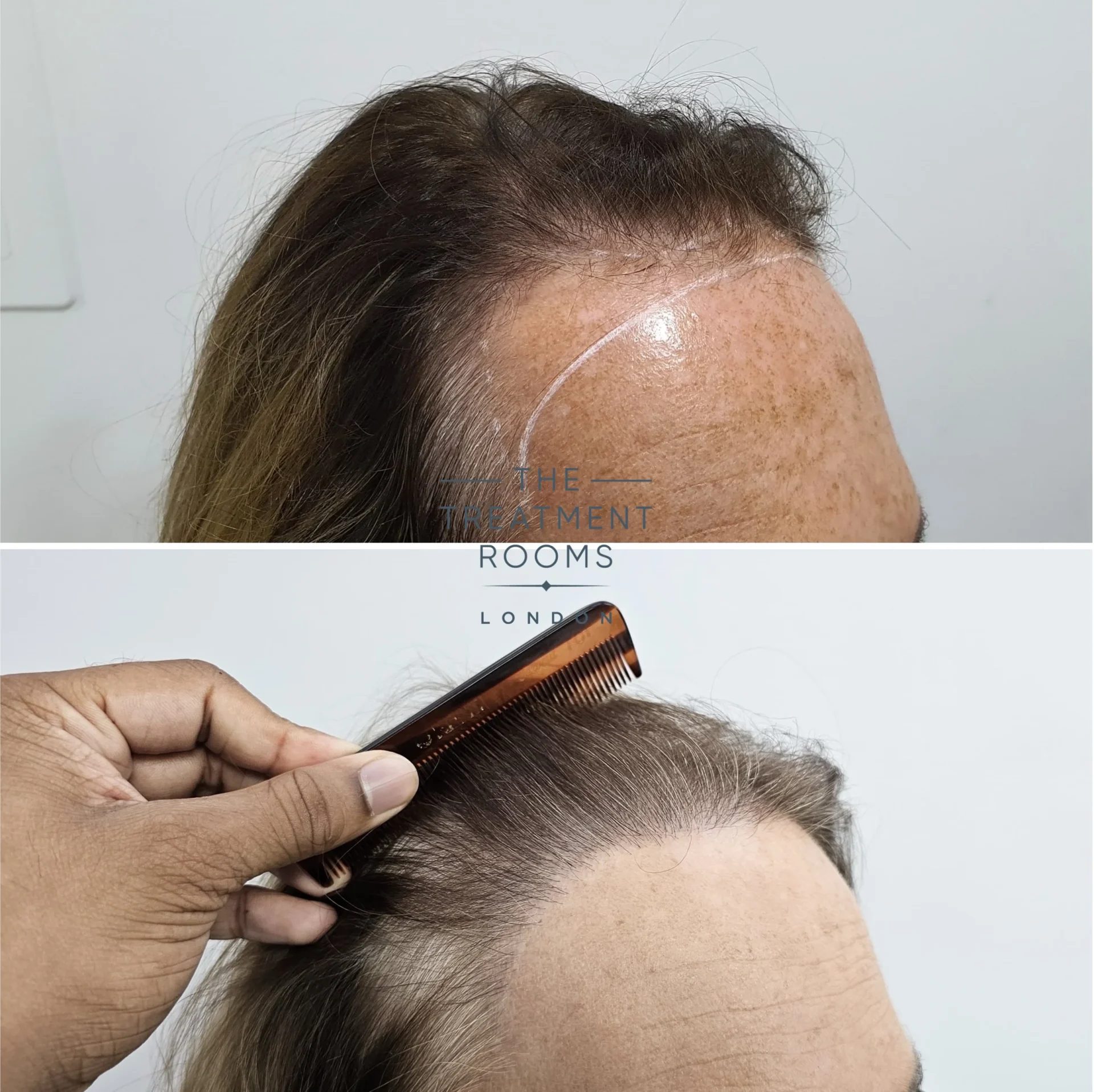 transgender hair transplant clinic before and after 2483 grafts