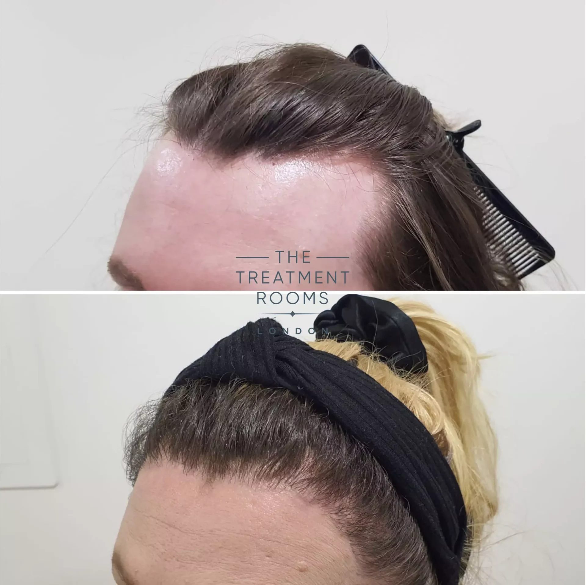 transgender hair transplant london 2319 grafts