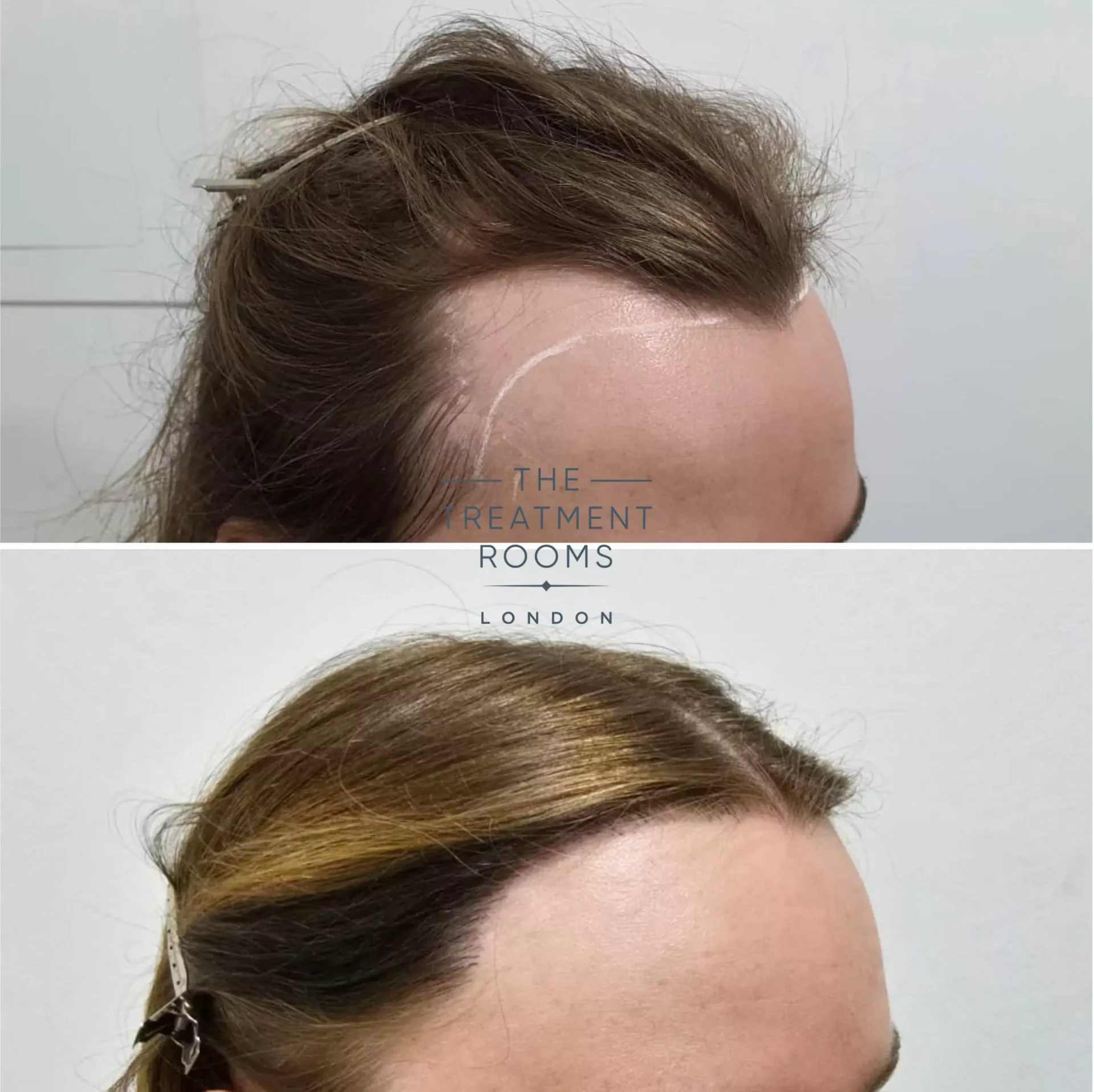 transgender hairline transplant cost