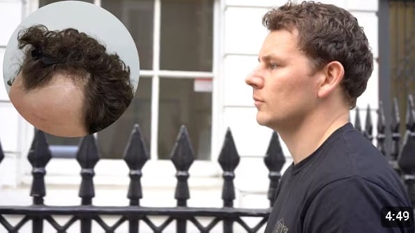 Tyler's FUE Transplant Review- 1243 Grafts