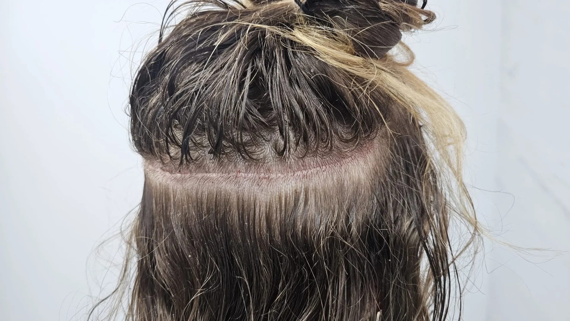 unshaven FUT hair transplant