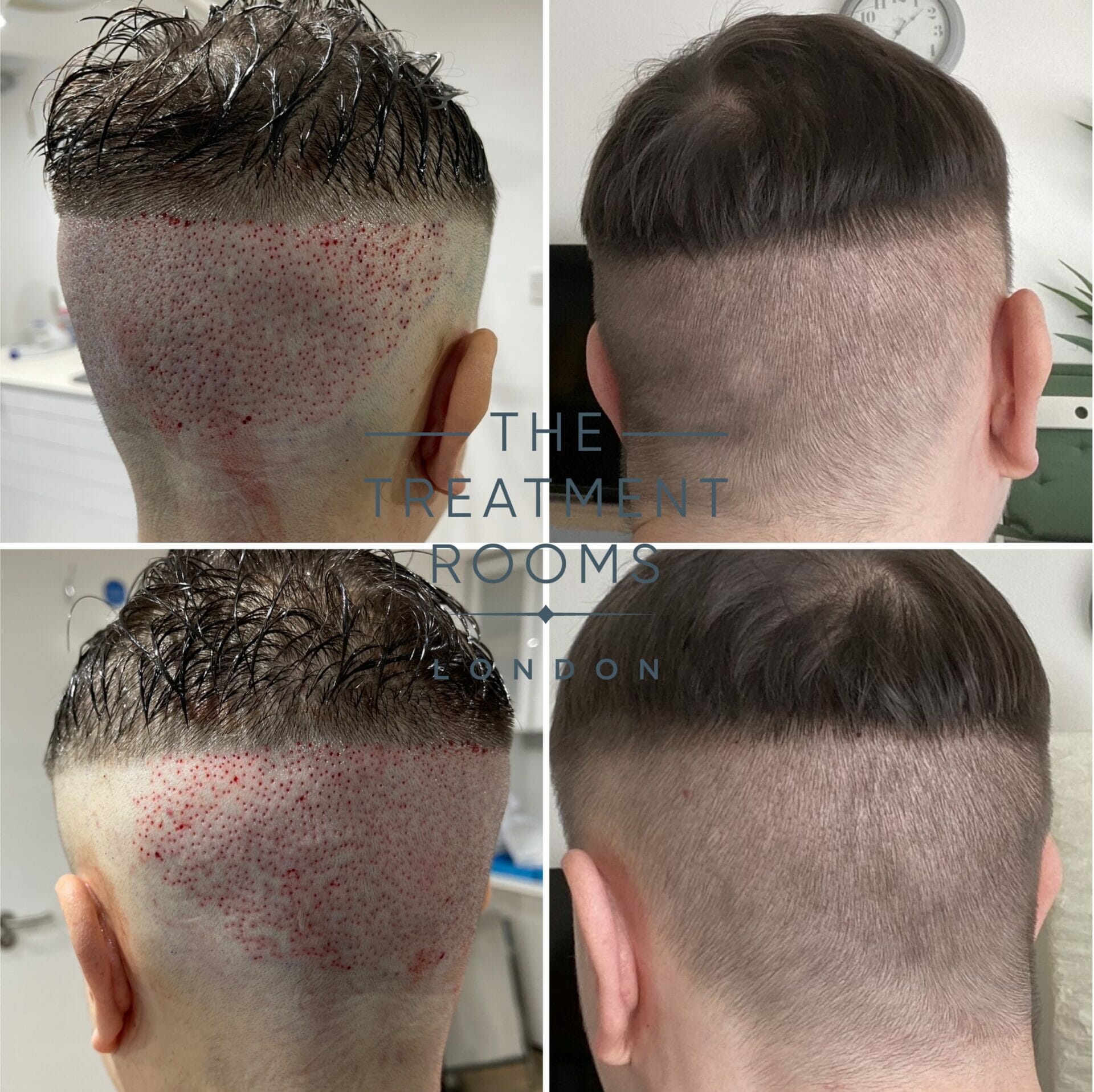 Donor Area healing process in with minimal shave