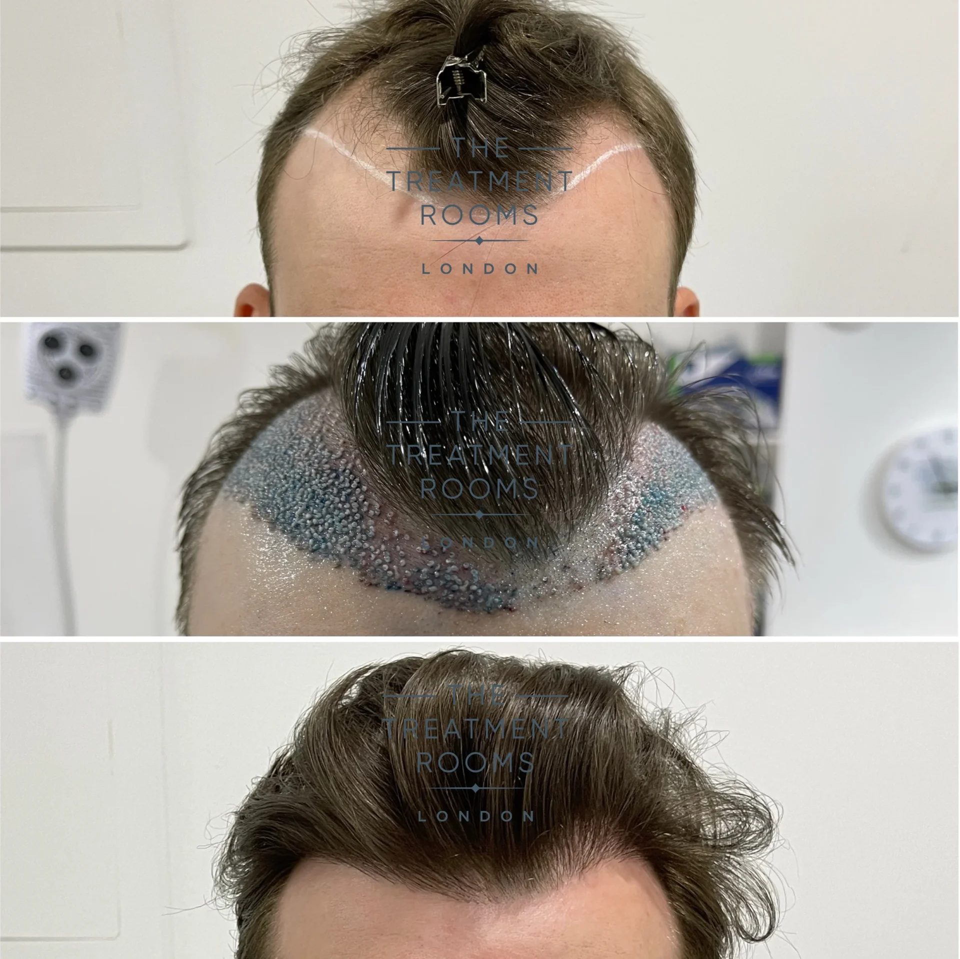 unshaven hair transplant for widow's peak