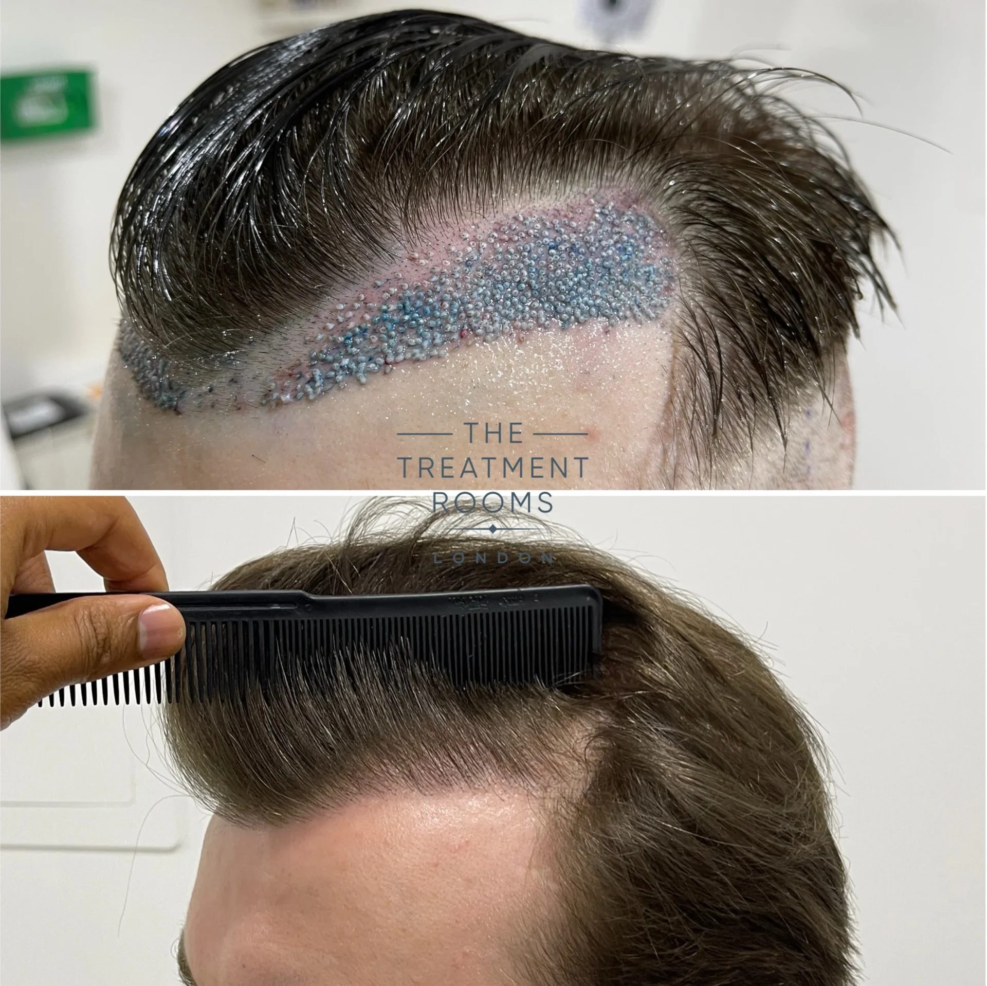 unshaven hair transplant hairline