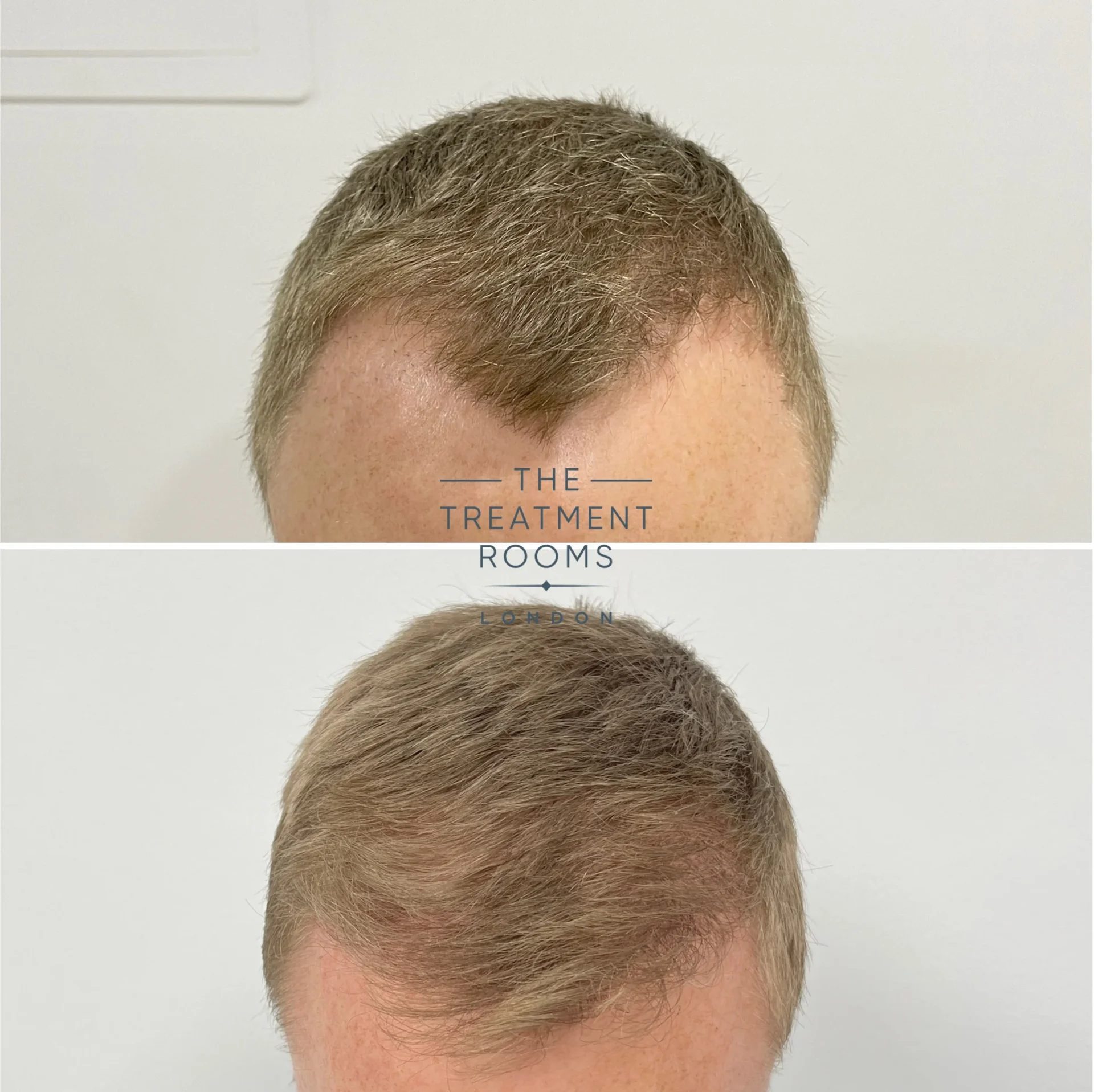 v shaped mature hairline example