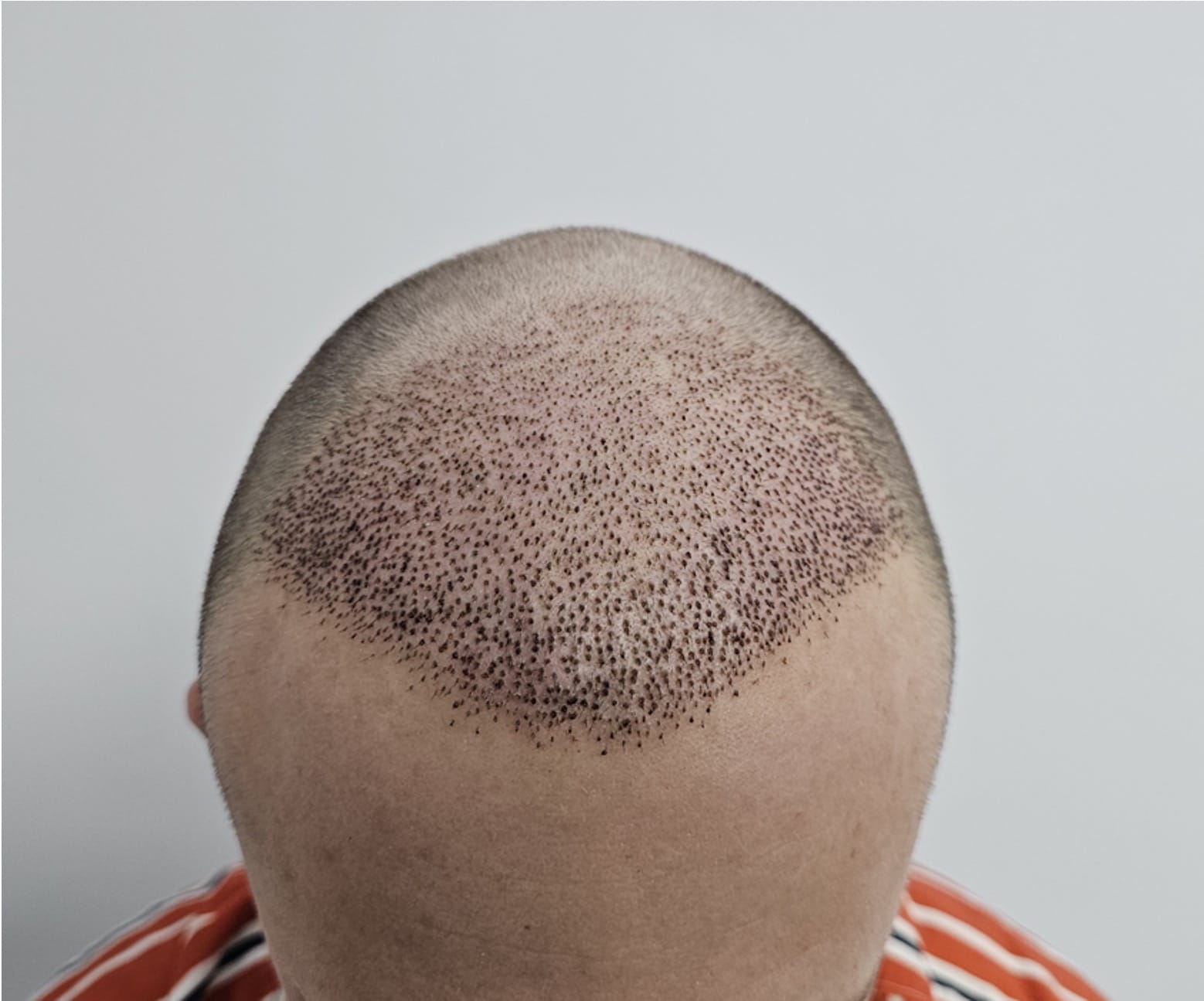 when can i remove scabs after a hair transplant