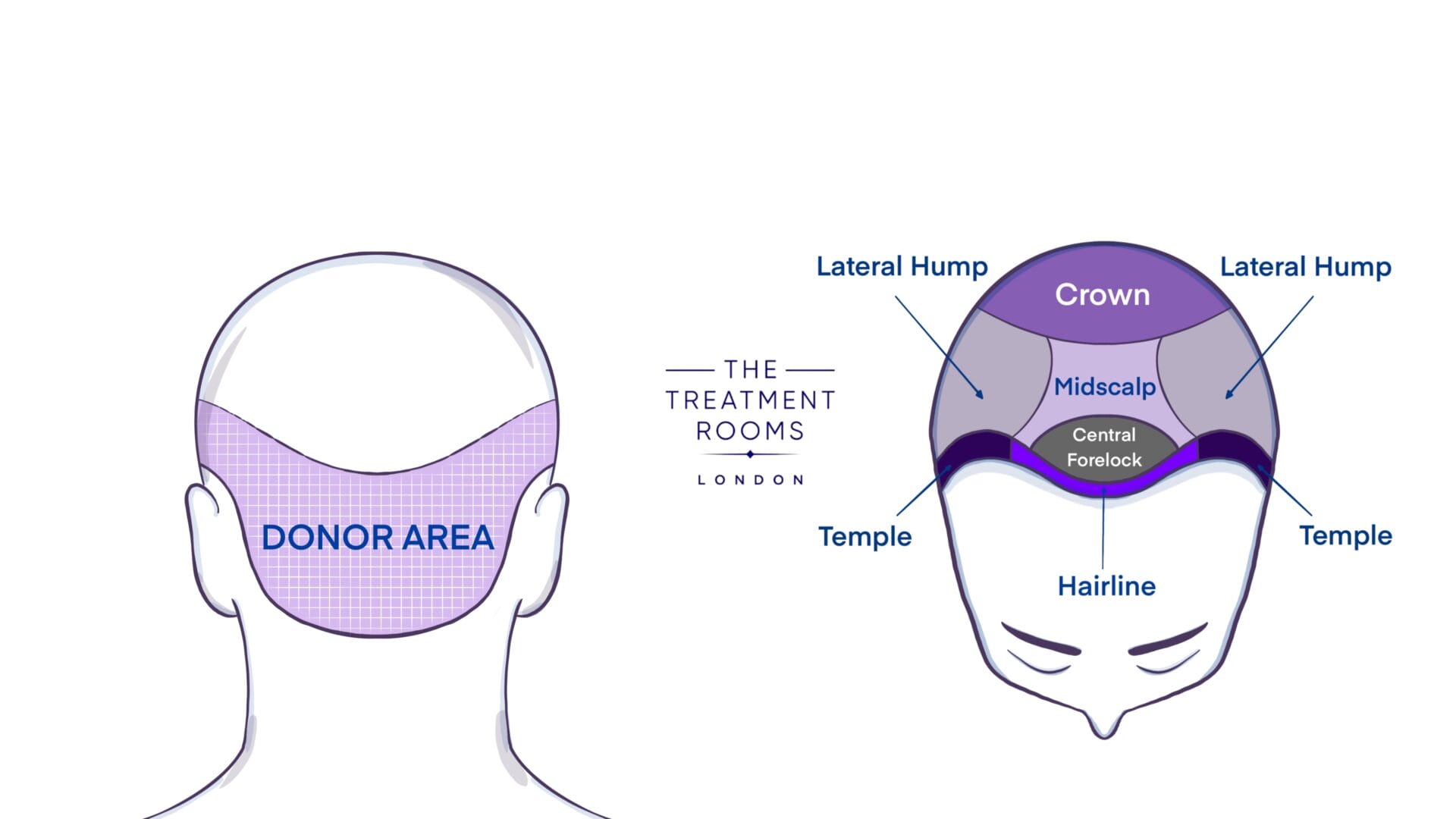 when can you walk after having a hair transplant