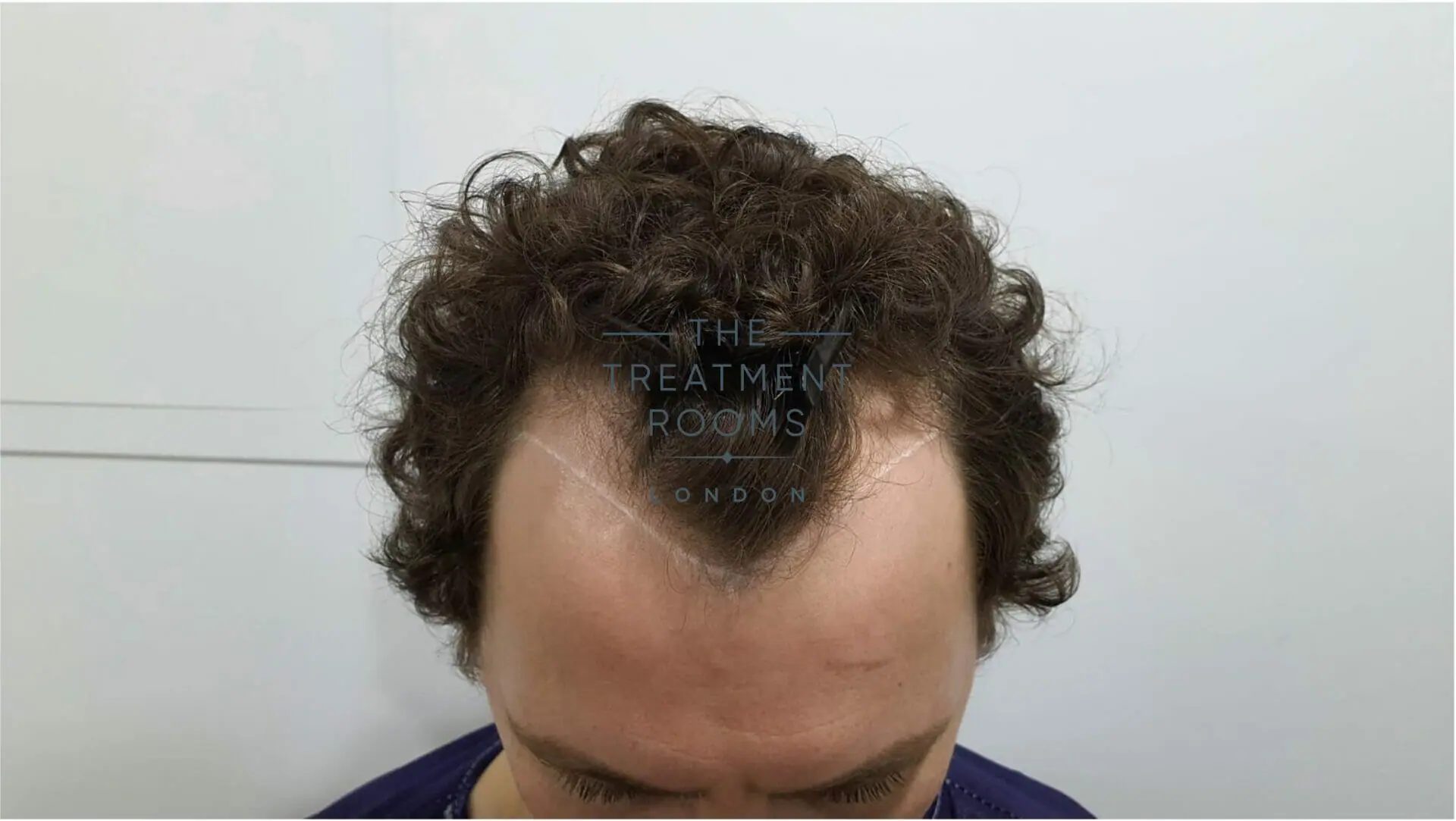 widow's peak example