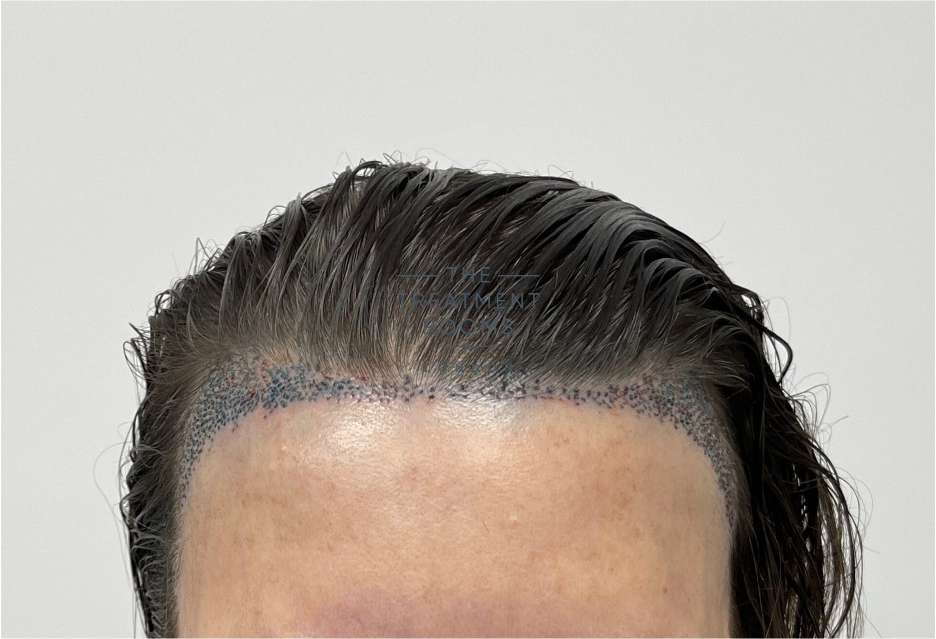 widows peak hair transplant for women