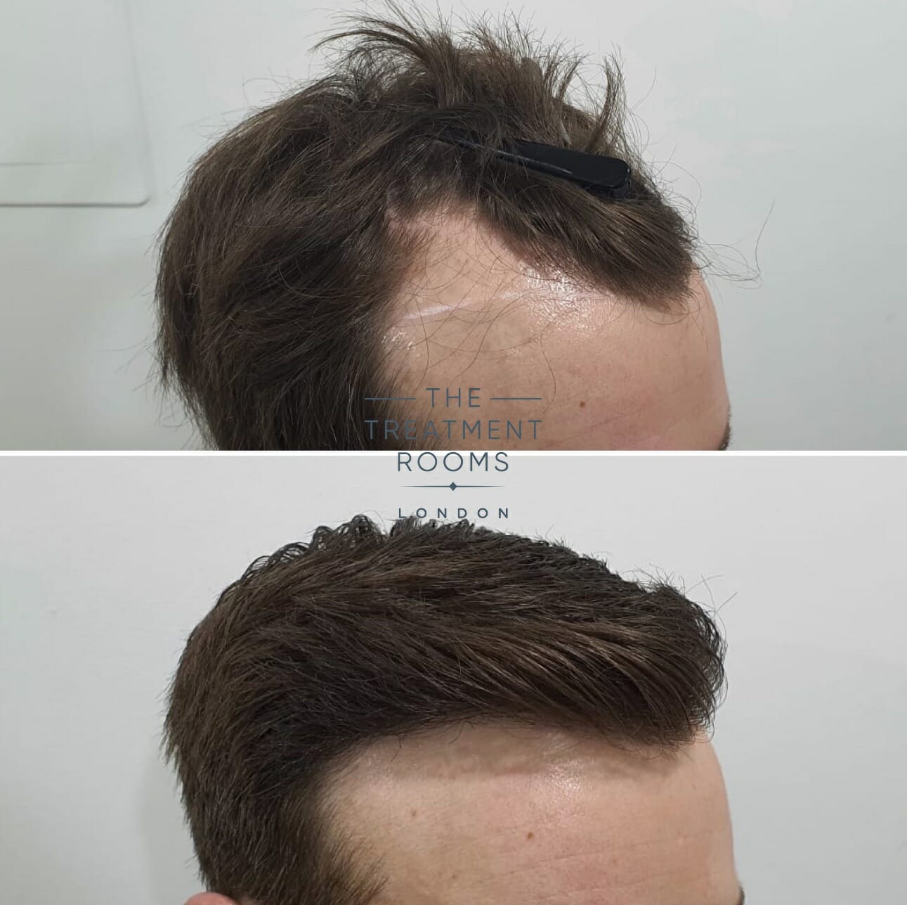 widows peak hair transplant